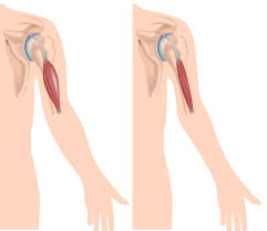 Cơ Bethlem - Hình ảnh minh họa